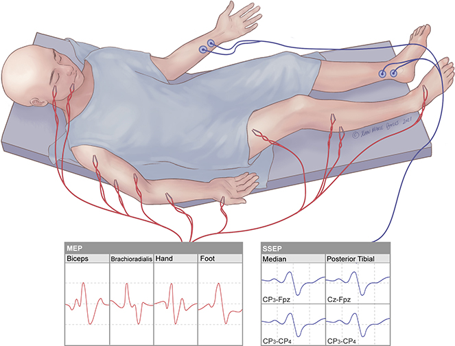 Intraoperative Nerve Stimulation: A Simple, Effective, and