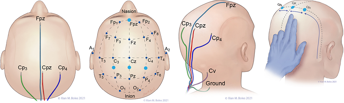 The use of a nerve stimulator for intraoperative stimulation of